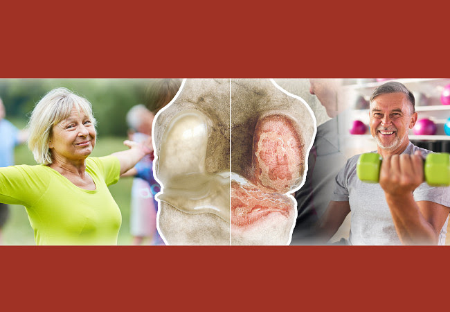 Why Osteoarthritis Is Such A Pain And How Physical Therapy Can Help